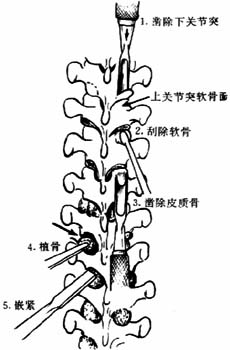 Harrington手术图片