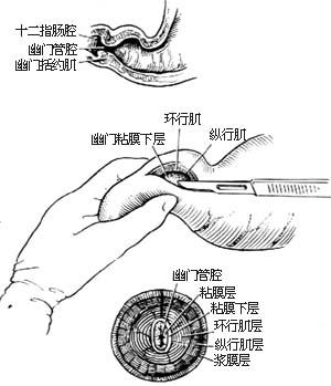 幽门括约肌切开术图片