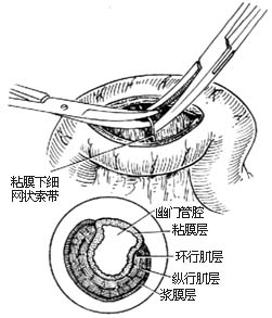 幽门括约肌切开术图片