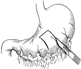管式胃造瘘术图片