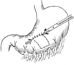 活瓣管式胃造瘘术图片