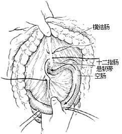 胃空肠吻合术图片