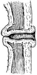 活瓣管式胃造瘘术图片
