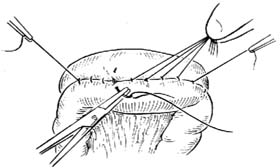 胃空肠吻合术图片