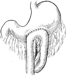 胃空肠吻合术图片