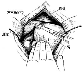 迷走神经干切断术图片