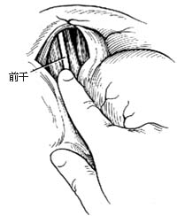 迷走神经干切断术图片