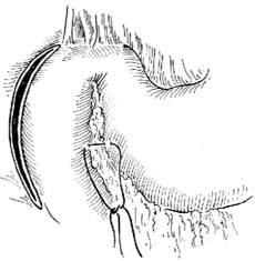 胃、十二指肠吻合术图片