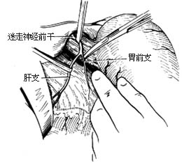 选择性胃迷走神经切断术图片