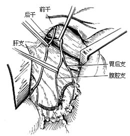 选择性胃迷走神经切断术图片