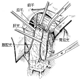 选择性胃迷走神经切断术图片