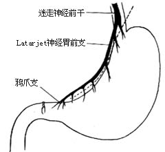 高度选择性胃迷走神经干切断术图片