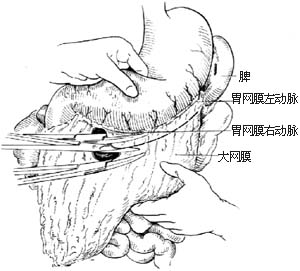 胃次全切除胃十二指肠吻合术图片