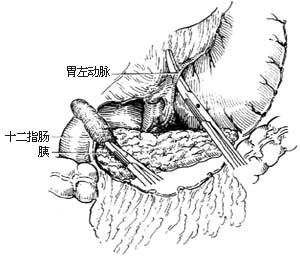 胃次全切除胃十二指肠吻合术图片