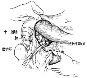 胃次全切除胃十二指肠吻合术图片