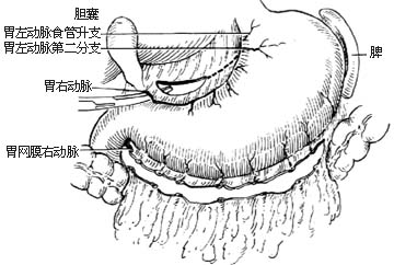 胃次全切除胃十二指肠吻合术图片