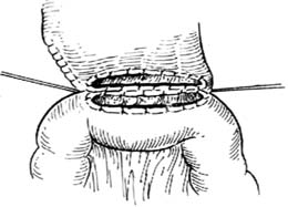 胃次全切除结肠前半口水平位胃空肠吻合术图片
