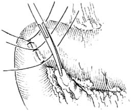 胃、十二指肠溃疡穿孔修补术图片