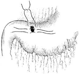 胃、十二指肠溃疡穿孔修补术图片