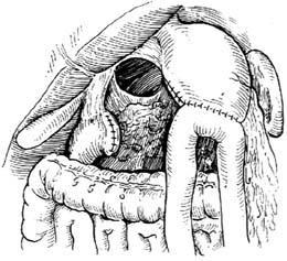 胃次全切除结肠前半口水平位胃空肠吻合术图片