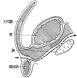 胃癌根治术图片