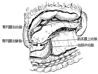 胃癌根治术图片