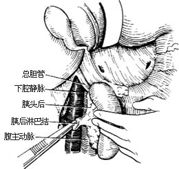 胃癌根治术图片