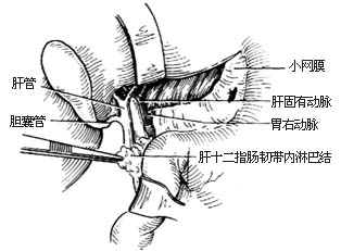 胃癌根治术图片