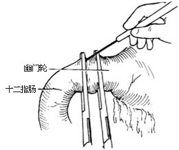 胃癌根治术图片