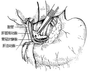 胃癌根治术图片