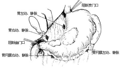 胃癌根治术图片