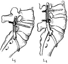 腰椎滑脱复位内固定手术图片