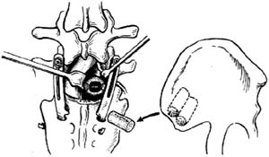 腰椎滑脱复位内固定手术图片