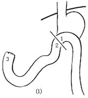 反流性胃炎手术图片