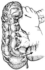肠套叠复位术图片