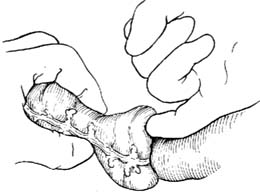 肠套叠复位术图片