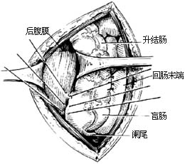 肠套叠复位术图片