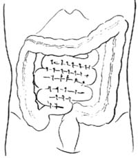 肠折叠术图片
