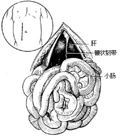 先天性肠旋转不全整复术图片