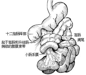 先天性肠旋转不全整复术图片