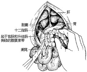 先天性肠旋转不全整复术图片