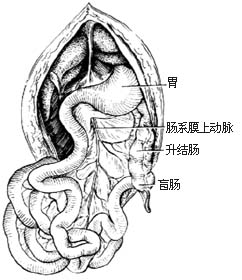 先天性肠旋转不全整复术图片