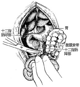 先天性肠旋转不全整复术图片