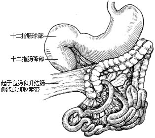 先天性肠旋转不全整复术图片