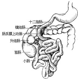 先天性肠旋转不全整复术图片