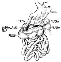 先天性肠旋转不全整复术图片