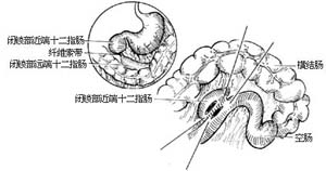 先天性肠闭锁和肠狭窄一期切除吻合术图片