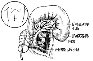 先天性肠闭锁和肠狭窄一期切除吻合术图片