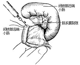 先天性肠闭锁和肠狭窄一期切除吻合术图片