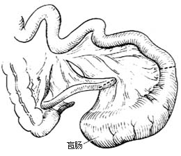 先天性肠闭锁和肠狭窄一期切除吻合术图片